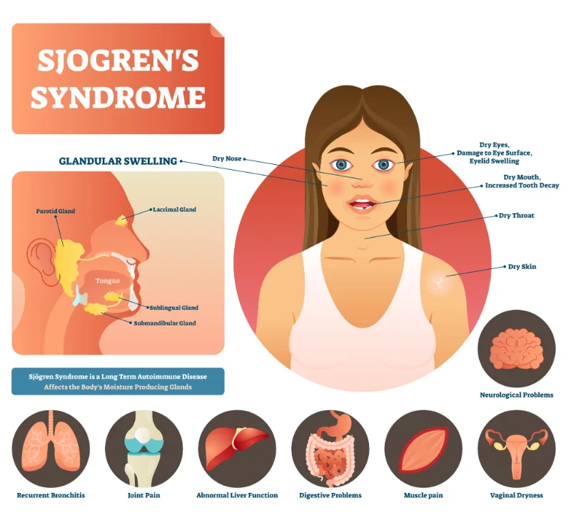 A graphic depicting which glands Sjogren’s Syndrome effects and some of the symptoms that may occur as a result, including dry mouth, dry eyes and others 
