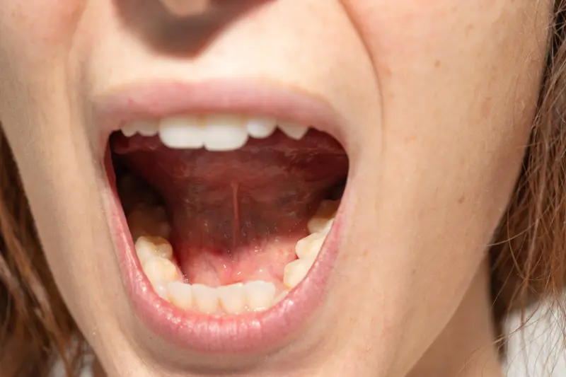 A person’s mouth who is using dry mouth gel