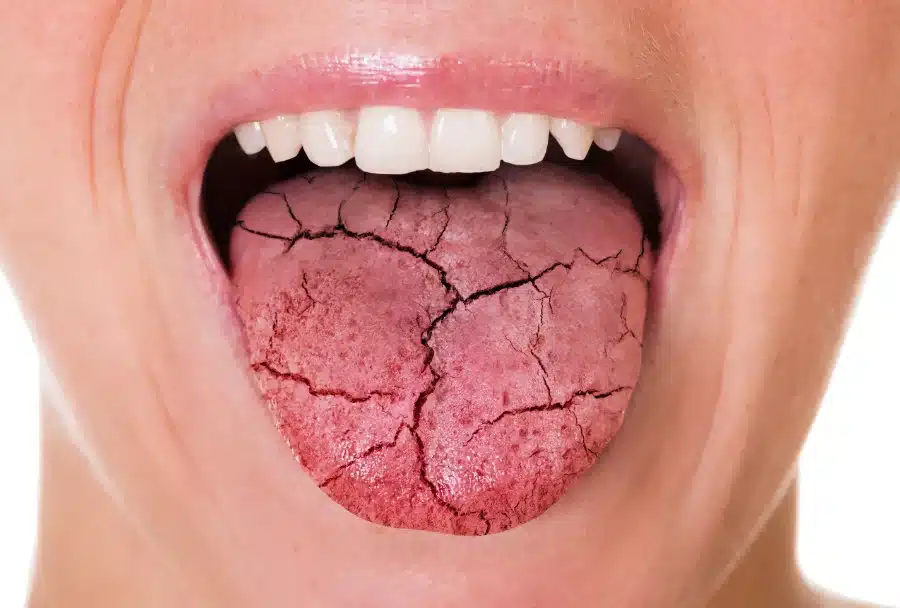  A person’s dry mouth resulting from breathing through mouth.